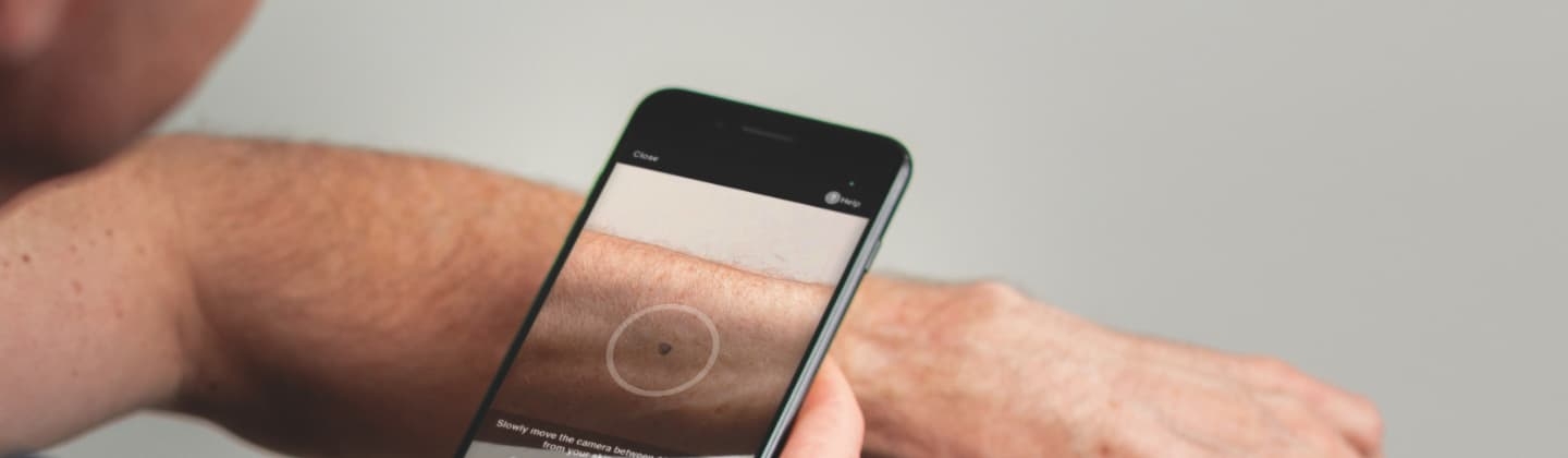 SkinVision App detects cancer.